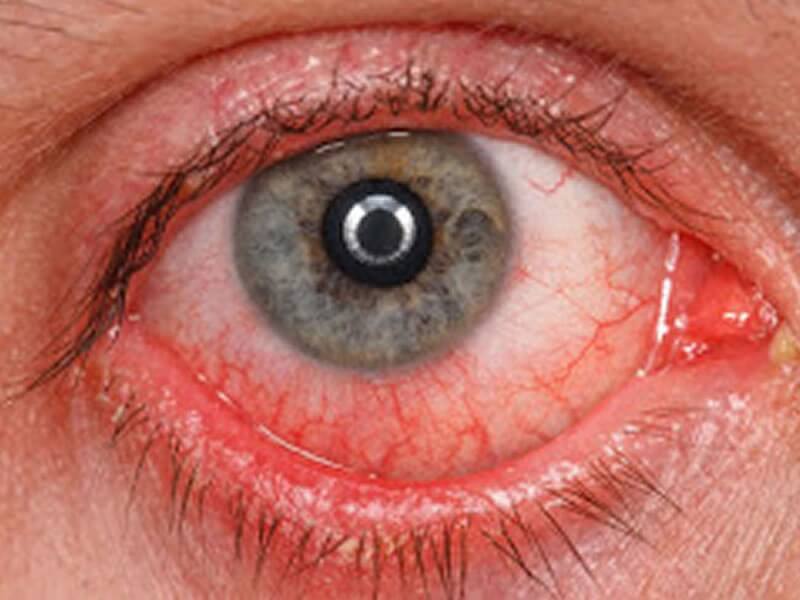 Olho vermelho : acordar com os olhos congestos s?o normal
