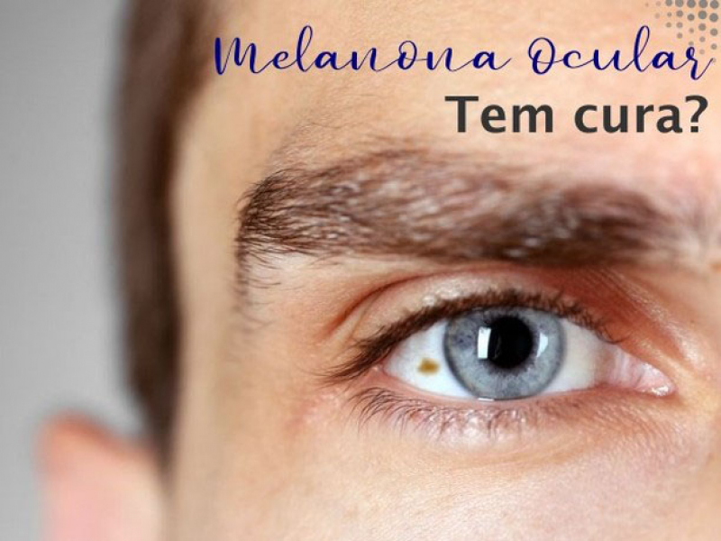 Como identificar o melanoma ocular?