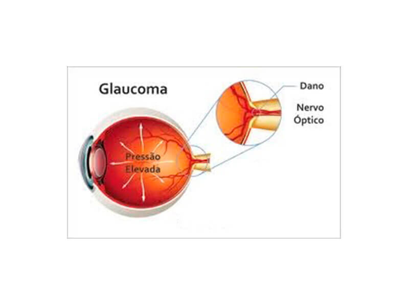 Glaucoma - 2